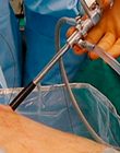 En Hospital Clínico del Sur se realiza exitosa Cirugía Renal Percutánea